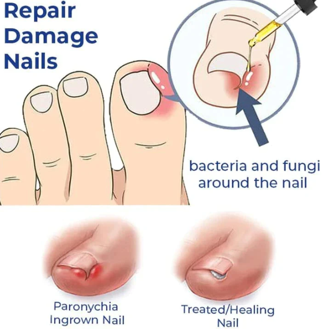 Anti Paronychia Relief Oil ( BUY 1 GET 1 FREE )