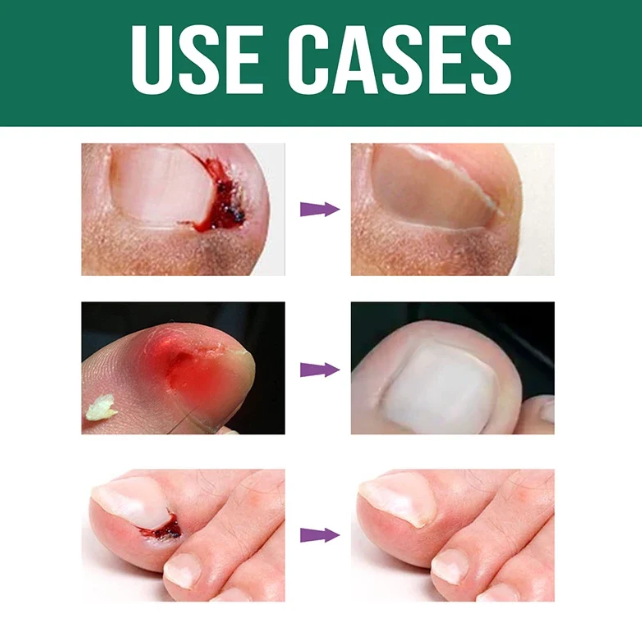 Anti Paronychia Relief Oil ( BUY 1 GET 1 FREE )