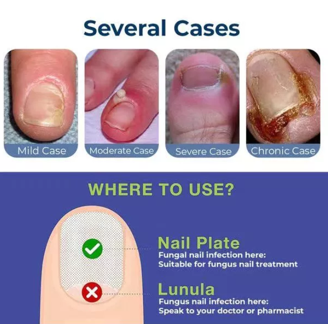 Anti Paronychia Relief Oil ( BUY 1 GET 1 FREE )