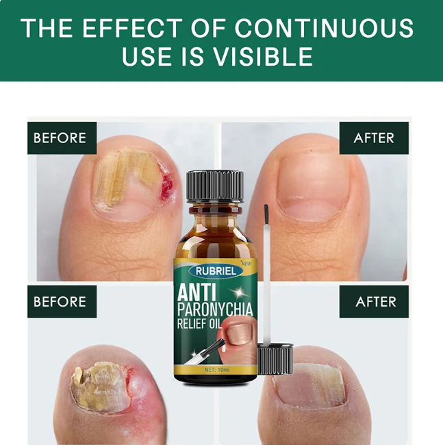 Anti Paronychia Relief Oil ( BUY 1 GET 1 FREE )